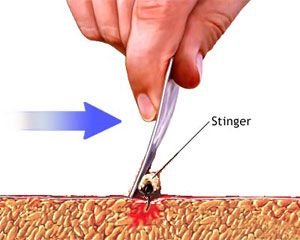 how to remove the stinger of a bee or wasp